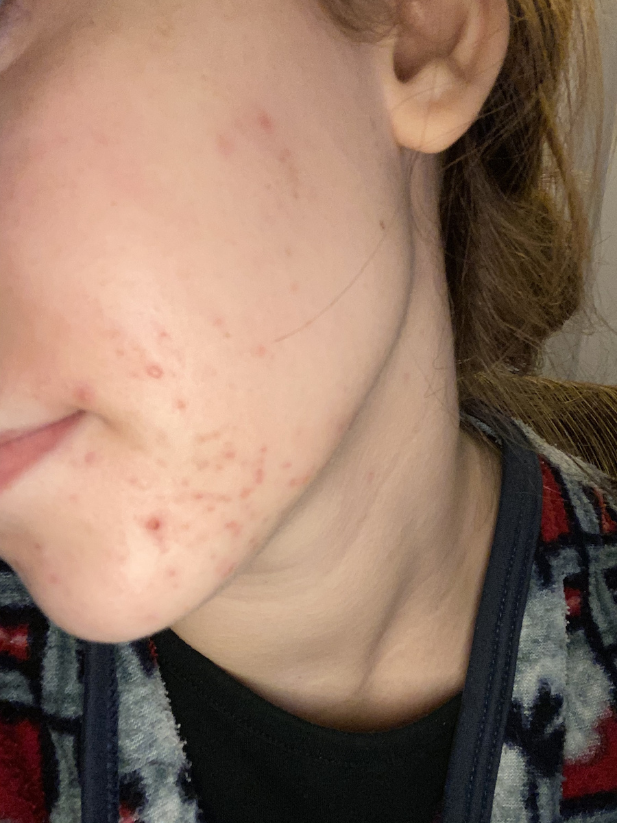 La Roche Posay Effaclar Ultra Concentrated Serum Face with Salicylic Acid for Acne & Imperfections 30ml