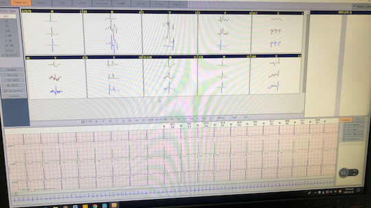 Borsam ECG Patch Holter Ρυθμού 3 Απαγωγών