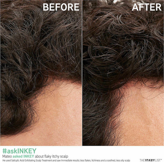 The Inkey List Salicylic Acid Lotion Μαλλιών για Αναδόμηση 150ml