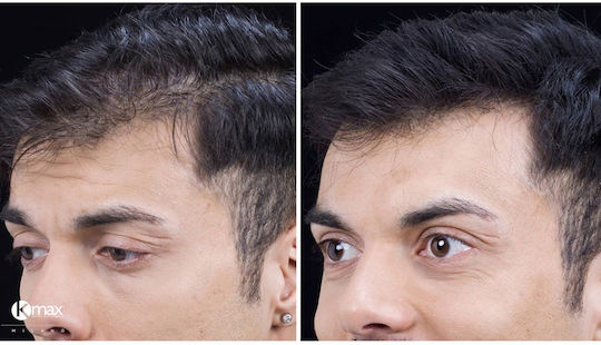 Kmax Milano Hair Thinning Coverage Fibers with Keratin Hair Fibers Regular 15g