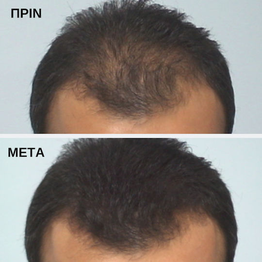 Toppik Hair Building Fibers with Keratin Hair Building Fibers Economy Medium Blonde 27.5gr
