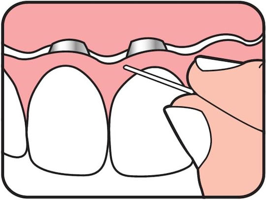Te Pe Bridge Implant Floss Νήμα Καθαρισμού Γεφυρών & Εμφυτευμάτων 30 Τεμάχια