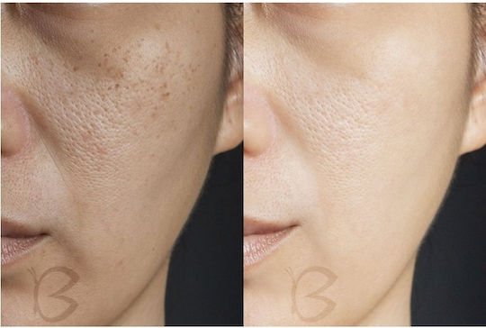 Beautifly B-derma Ice Συσκευή Προσώπου με Αναρρόφηση