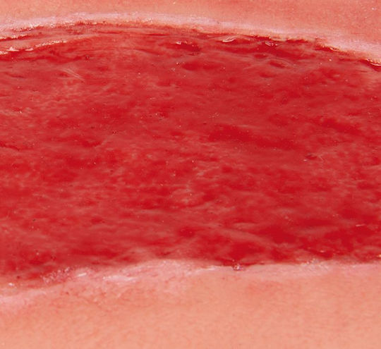 Large Arterial Ulcer Leg Wound Granulation Phase Erler Zimmer