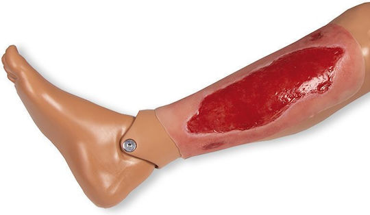 Large Arterial Ulcer Leg Wound Granulation Phase Erler Zimmer