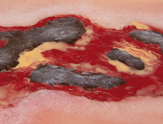 Large Arterial Ulcer Wound of the Foot Exudation Phase Erler Zimmer