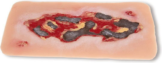Large Arterial Ulcer Wound of the Foot Exudation Phase Erler Zimmer