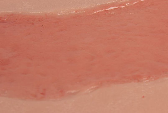 Large Arterial Ulcer Foot Wound Epithelium Phase Erler Zimmer