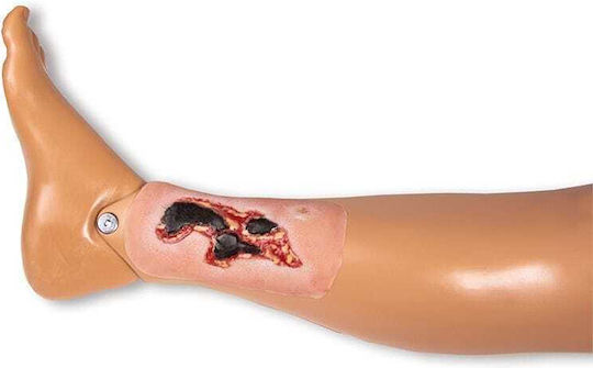 Small Arterial Ulcer Leg Wound Exudation Phase Erler Zimmer