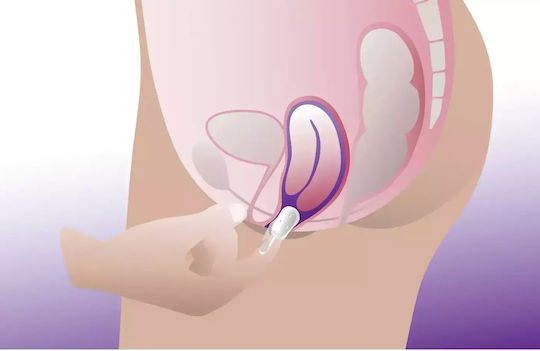 ProFem Cubeo Vaginal-Pessar 56mm 56mm