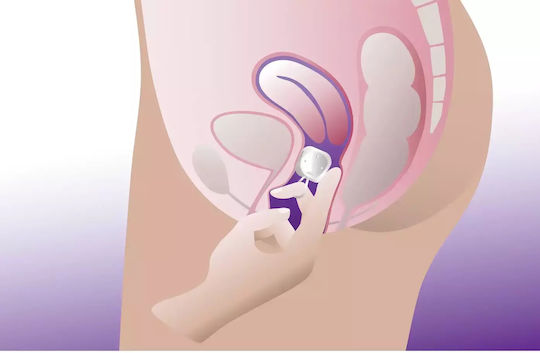 ProFem Cubeo Vaginal-Pessar 56mm 56mm