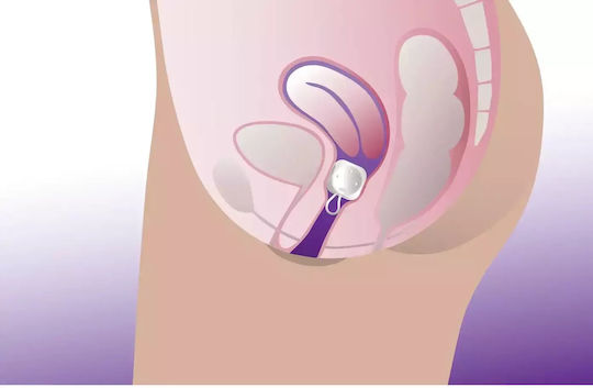 ProFem Cubeo Vaginal-Pessar 56mm 56mm