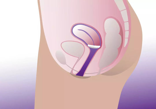ProFem Shaatz Vaginal-Pessar 83mm