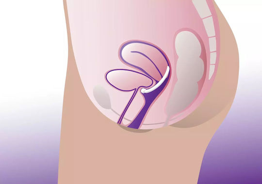 Vaginalpessar Ringpessar Knopf Profem