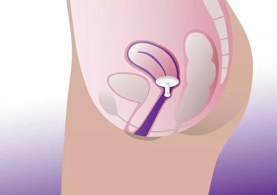 Gellhorn Vaginal Pessary Long Stem Profem