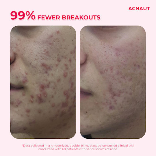 Biotrade ACNAUT Aktive Creme Für Haut Mit Akne 30ml