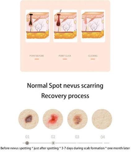 Συσκευή Microneedling για Καθαρισμό από Μαύρα Στίγματα MYD16