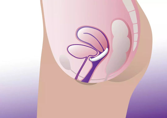 ProFem Vaginal-Pessar Dish Pessary