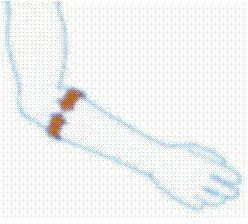 Δέστρα Επικονδυλίτιδας Tennis Elbow Σιλικόνη