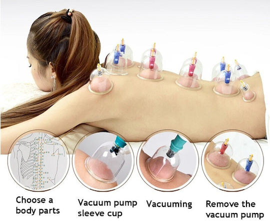 Set of 18 Traditional Therapy Suction Cups