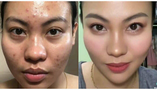 Anti-wrinkle Cream Healing Pharma Tretiheal Anti-acne Tretinoin 0.025% 20g