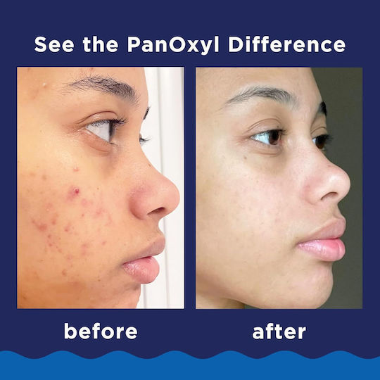 PanOxyl Spumă de Curățare pentru Față, Ochi și Buze, Împotriva Imperfecțiunilor 28 g