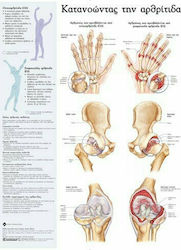 Ανατομικός Χάρτης: Κατανοώντας την Αρθρίτιδα