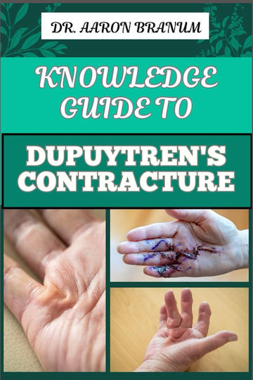Knowledge Guide To Dupuytren’s Contracture Comprehensive Manual To Symptoms Treatments And Preventative Care For Hand Health And Mobility